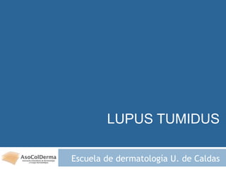 LUPUS TUMIDUS
Escuela de dermatología U. de Caldas
 