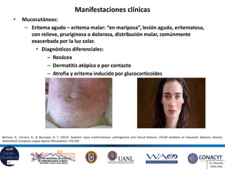 Lupus y síndrome antifosfolípido | PDF