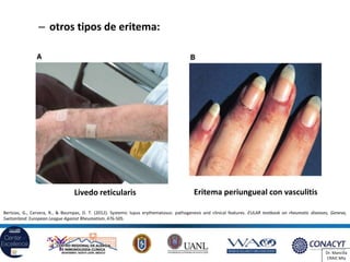 Lupus y síndrome antifosfolípido | PDF