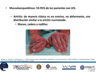Lupus y síndrome antifosfolípido | PDF