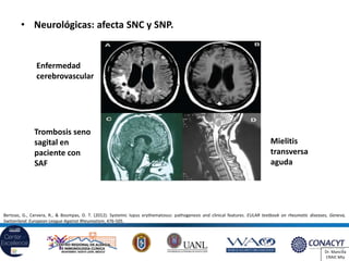 Lupus y síndrome antifosfolípido | PDF