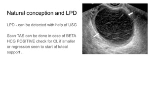 Natural conception and LPD
LPD - can be detected with help of USG
Scan TAS can be done in case of BETA
HCG POSITIVE check for CL if smaller
or regression seen to start of luteal
support .
 