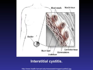 Interstitial cystitis. http://www.health.harvard.edu/newsweek/images/cystitis2.jpg 