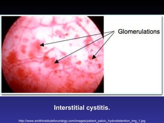 Interstitial cystitis. http://www.smithinstituteforurology.com/images/patient_pelvic_hydrodistention_img_1.jpg 