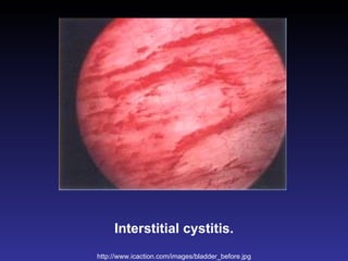 Interstitial cystitis. http://www.icaction.com/images/bladder_before.jpg 