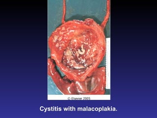 Cystitis with malacoplakia. 