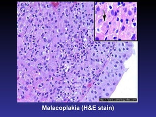Malacoplakia (H&E stain) 
