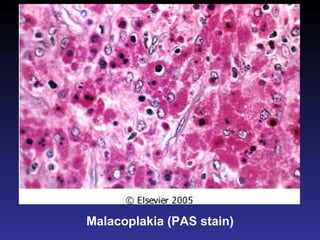 Malacoplakia (PAS stain) 