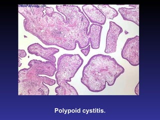 Polypoid cystitis. 