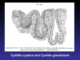 Cystitis cystica and Cystitis glandularis 