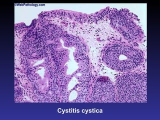 Cystitis cystica 