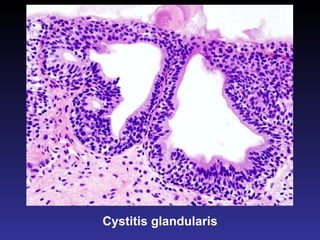 Cystitis glandularis 