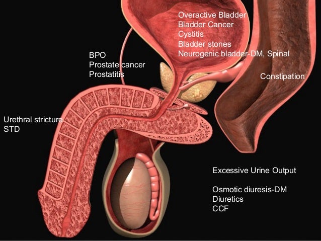 bladder stones symptoms lower urinary tract symptoms in for gps bladder stones symptoms lower urinary tract symptoms in for gps