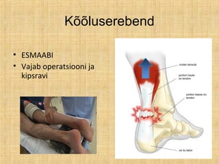 Kõõluserebend
• ESMAABI
• Vajab operatsiooni ja
kipsravi
 
