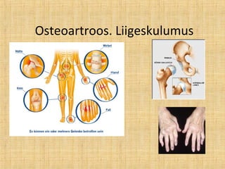 Osteoartroos. Liigeskulumus
 
