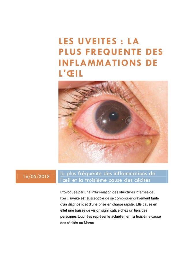 L Uveite L Inflammation Des Structures Internes De L Oeil