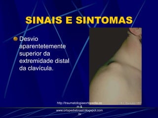 SINAIS E SINTOMAS
Desvio
aparentetemente
superior da
extremidade distal
da clavícula.
http://traumatologiaeortopedia.co
m &
www.ortopediabrasil.blogspot.com
.br
 