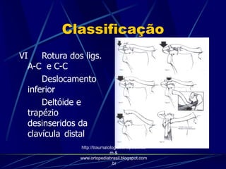 Classificação
VI Rotura dos ligs.
A-C e C-C
Deslocamento
inferior
Deltóide e
trapézio
desinseridos da
clavícula distal
http://traumatologiaeortopedia.co
m &
www.ortopediabrasil.blogspot.com
.br
 