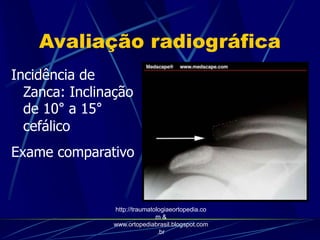 Avaliação radiográfica
Incidência de
Zanca: Inclinação
de 10° a 15°
cefálico
Exame comparativo
http://traumatologiaeortopedia.co
m &
www.ortopediabrasil.blogspot.com
.br
 