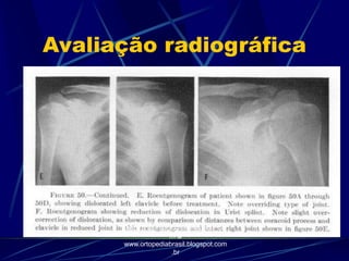 Avaliação radiográfica
http://traumatologiaeortopedia.co
m &
www.ortopediabrasil.blogspot.com
.br
 