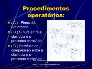 Procedimentos
operatórios:
( A )- Pinos de
Steinmann
( B ) Sutura entre a
clavícula e o
processo coracóide.
( C ) Parafuso de
compressão entre a
clavícula e o
processo coracóidehttp://traumatologiaeortopedia.co
m &
www.ortopediabrasil.blogspot.com
.br
 