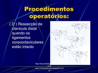 Procedimentos
operatórios:
( D ) Ressecção da
clavícula distal
quando os
ligamentos
coracoclaviculares
estão intacto
http://traumatologiaeortopedia.co
m &
www.ortopediabrasil.blogspot.com
.br
 