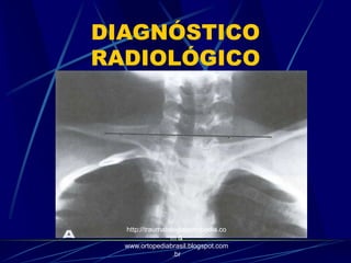 DIAGNÓSTICO
RADIOLÓGICO
http://traumatologiaeortopedia.co
m &
www.ortopediabrasil.blogspot.com
.br
 