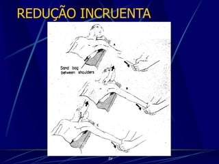 REDUÇÃO INCRUENTA
http://traumatologiaeortopedia.co
m &
www.ortopediabrasil.blogspot.com
.br
 
