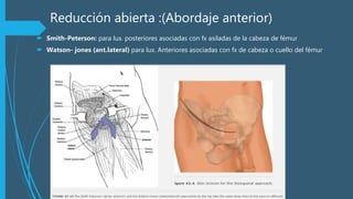 Reducción abierta :(Abordaje anterior)
 Smith-Peterson: para lux. posteriores asociadas con fx asiladas de la cabeza de fémur
 Watson- jones (ant.lateral) para lux. Anteriores asociadas con fx de cabeza o cuello del fémur
 