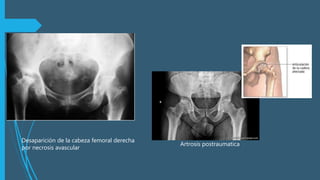 Artrosis postraumatica
Desaparición de la cabeza femoral derecha
por necrosis avascular
 
