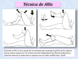 11 
Técnica de Allis 
Paciente en DS y con la ayuda de un asistente que sostenga la pelvis de las espinas 
iliacas antero superiores. Se realiza tracción longitudinal con flexión abducción y 
rotación externa; la reducción se expresa con un ruido audible tipo “clunk” 
 