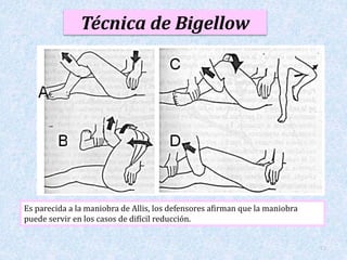 Técnica de Bigellow 
13 
Es parecida a la maniobra de Allis, los defensores afirman que la maniobra 
puede servir en los casos de difícil reducción. 
 