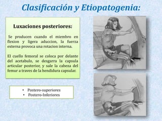 Clasificación y Etiopatogenia: 
Luxaciones posteriores: 
Se producen cuando el miembro en 
flexion y ligera aduccion, la fuerza 
externa provoca una rotacion interna. 
EI cuello femoral se coloca por delante 
del acetabulo, se desgarra la capsula 
articular posterior, y sale la cabeza del 
femur a traves de la hendidura capsular. 
• Postero-superiores 
• Postero-Inferiores 
 