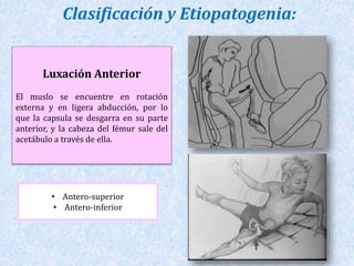 Clasificación y Etiopatogenia: 
Luxación Anterior 
El muslo se encuentre en rotación 
externa y en ligera abducción, por lo 
que la capsula se desgarra en su parte 
anterior, y la cabeza del fémur sale del 
acetábulo a través de ella. 
• Antero-superior 
• Antero-inferior 
 