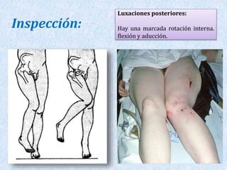 Luxaciones posteriores: 
Hay una marcada rotación interna. 
flexión y aducción. 
Inspección: 
 