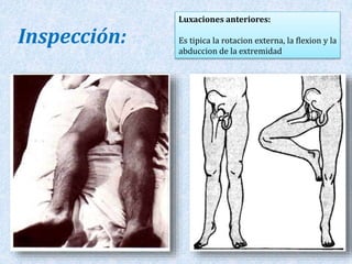 Luxaciones anteriores: 
Es tipica la rotacion externa, la flexion y la 
abduccion de la extremidad 
Inspección: 
 