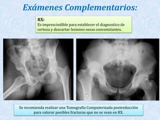 Exámenes Complementarios: 
RX: 
Es imprescindible para establecer el diagnostico de 
certeza y descartar lesiones oseas concomitantes. 
Se recomienda realizar una Tomografía Computerizada postreducción 
para valorar posibles fracturas que no se vean en RX. 
 