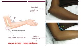 45 °
45 °
Olecranon prominente
Olecrano
n
prominent
e
Edema y
deformació
n
REVISAR NERVIOS Y PULSOS PERIFÉRICOS
 