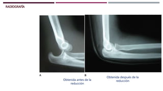 RADIOGRAFÍA
Obtenida antes de la
reducción
Obtenida después de la
reducción
 