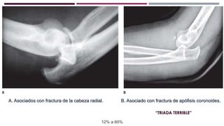 A. Asociados con fractura de la cabeza radial. B. Asociado con fractura de apófisis coronoides.
“TRIADA TERRIBLE”
12% a 60%
 