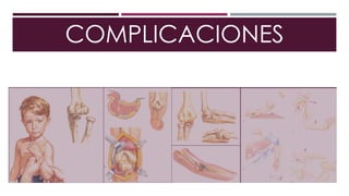 COMPLICACIONES
 