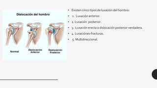 • Existen cinco tipos de luxación del hombro:
• 1. Luxación anterior.
• 2. Luxación posterior.
• 3. Luxación erecta o dislocación posterior verdadera.
• 4. Luxaciónes-fracturas.
• 5. Multidireccional.
 