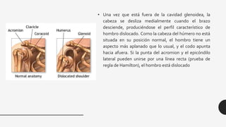 • Una vez que está fuera de la cavidad glenoidea, la
cabeza se desliza medialmente cuando el brazo
desciende, produciéndose el perfil característico de
hombro dislocado. Como la cabeza del húmero no está
situada en su posición normal, el hombro tiene un
aspecto más aplanado que lo usual, y el codo apunta
hacia afuera. Si la punta del acromion y el epicóndilo
lateral pueden unirse por una línea recta (prueba de
regla de Hamilton), el hombro está dislocado
 