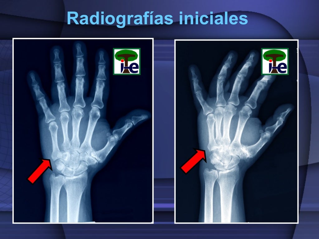 Rehabilitación De Fractura De 5 Metacarpiano Luxación de la base del 5º metacarpiano