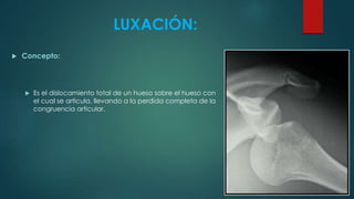 LUXACIÓN:
 Concepto:
 Es el dislocamiento total de un hueso sobre el hueso con
el cual se articula, llevando a la perdida completa de la
congruencia articular.
 