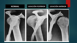 NORMAL LUXACIÓN POSTERIOR LUXACIÓN ANTERIOR
 