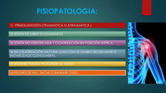 Luxación escapulo humeral