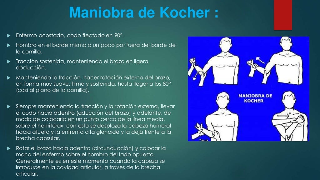 Luxación escapulo humeral