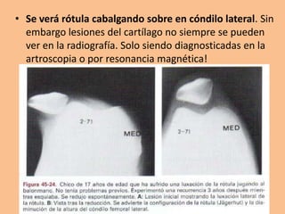 • Se verá rótula cabalgando sobre en cóndilo lateral. Sin
  embargo lesiones del cartílago no siempre se pueden
  ver en la radiografía. Solo siendo diagnosticadas en la
  artroscopia o por resonancia magnética!
 