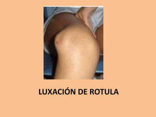 LUXACIÓN DE ROTULA
 
